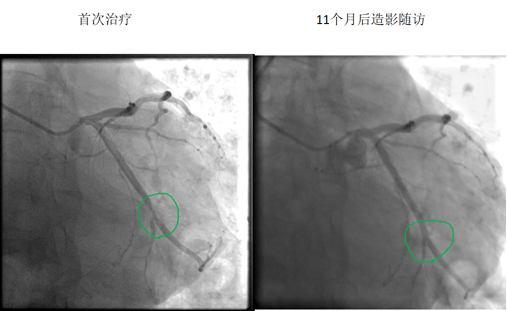 藥物球囊治療原位病變(圖1)