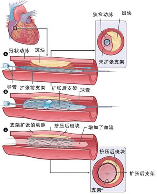 怎樣治療冠心?。?圖2)