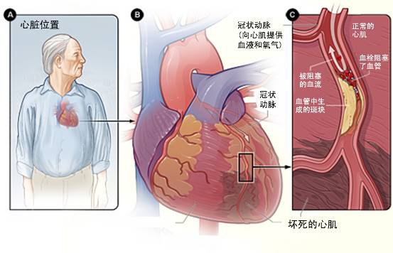 怎樣治療冠心??？(圖3)